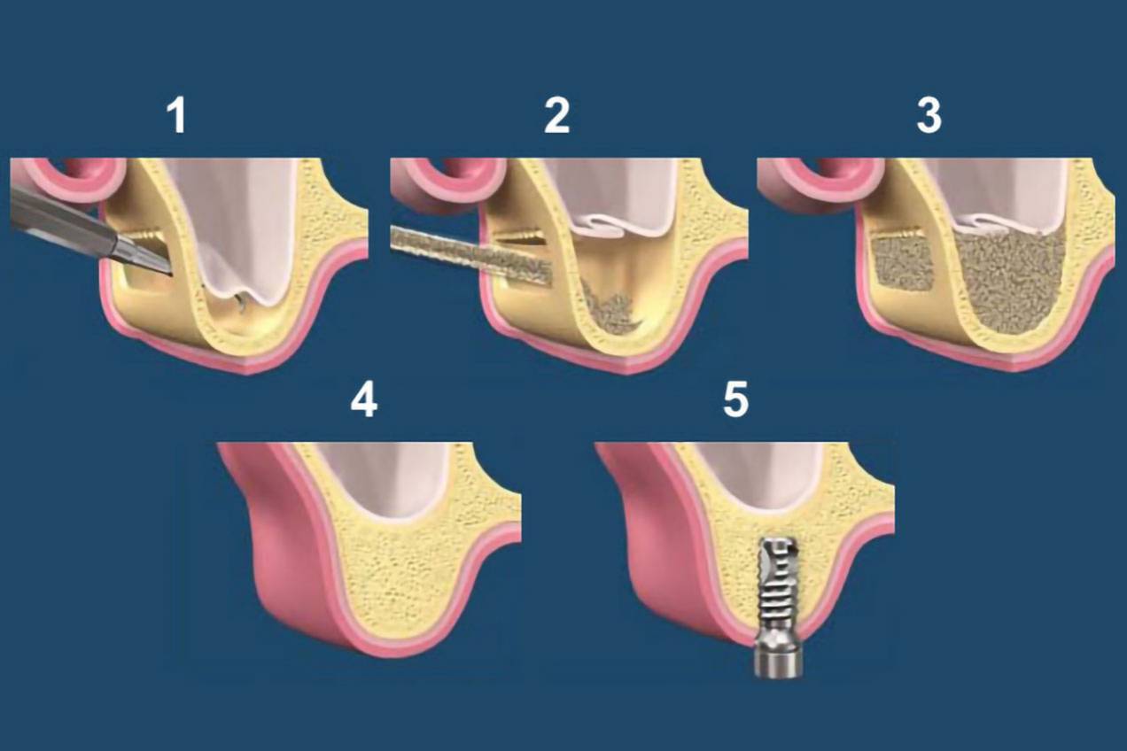 rialzo_mascella01_desk