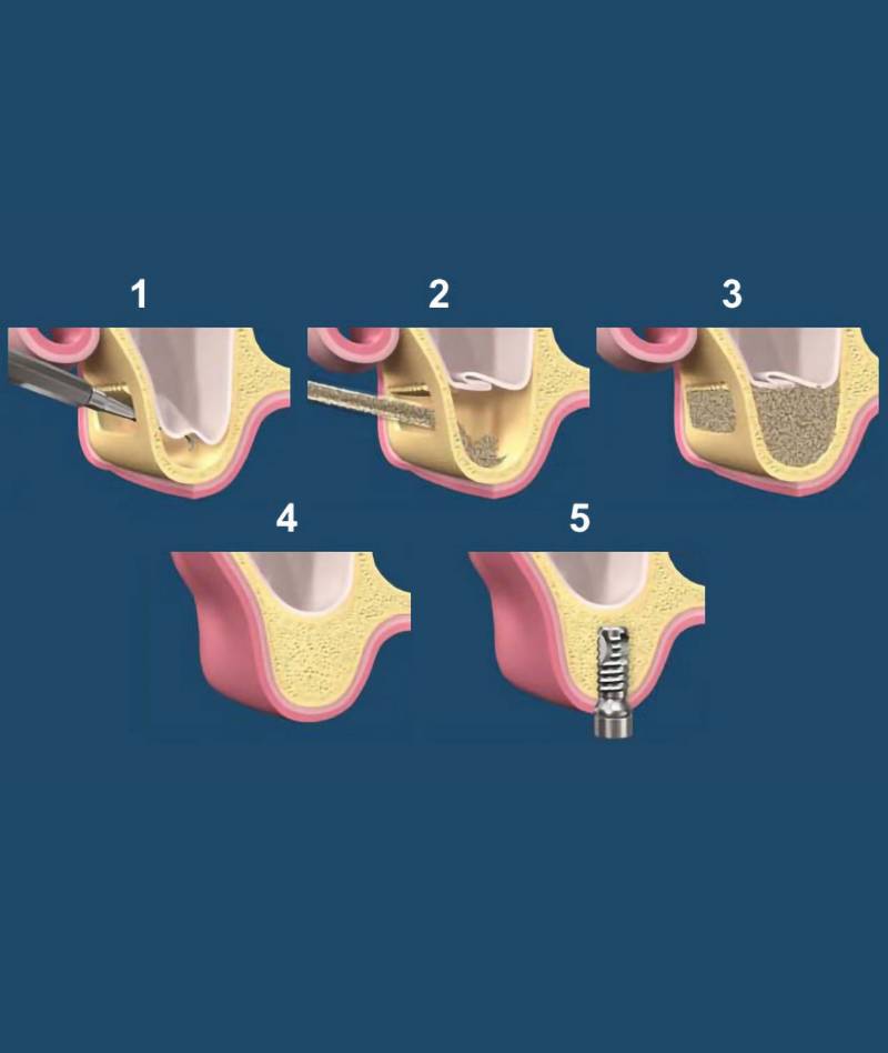 rialzo_mascella01_mob