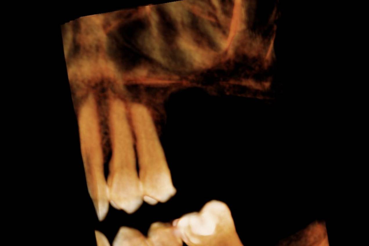 rialzo_mascella02_desk