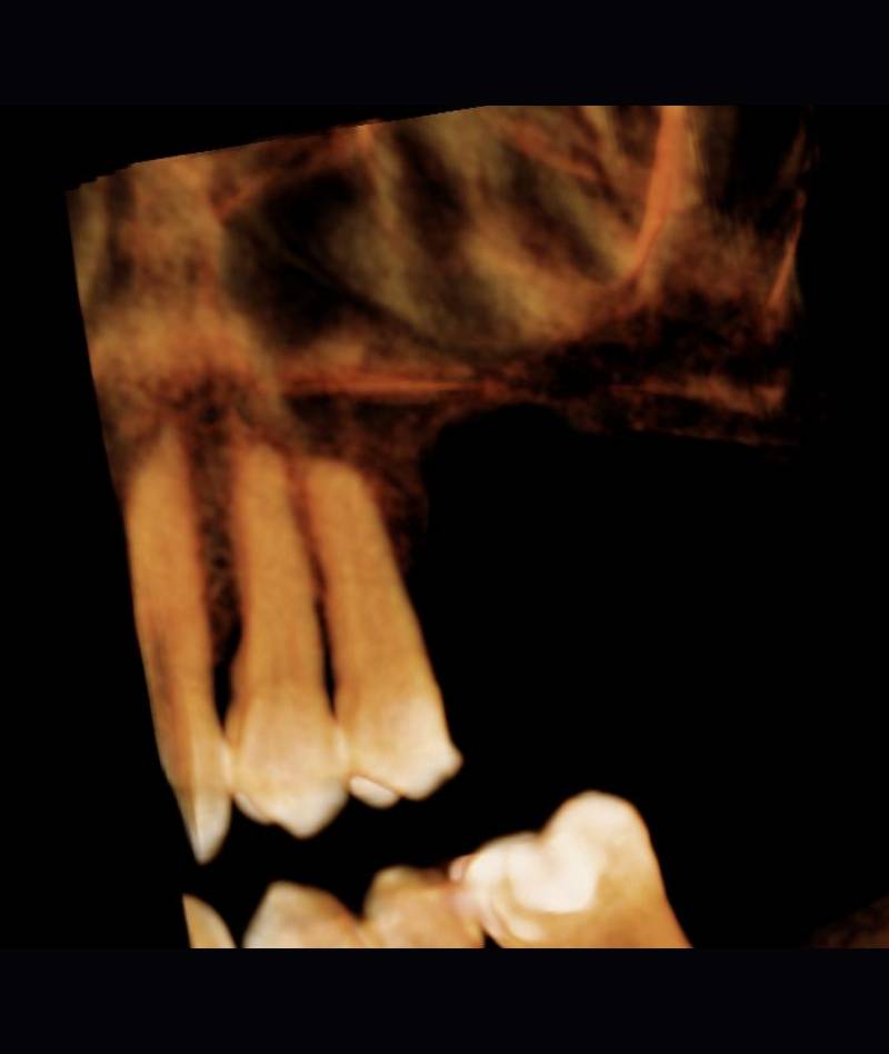 rialzo_mascella02_mob