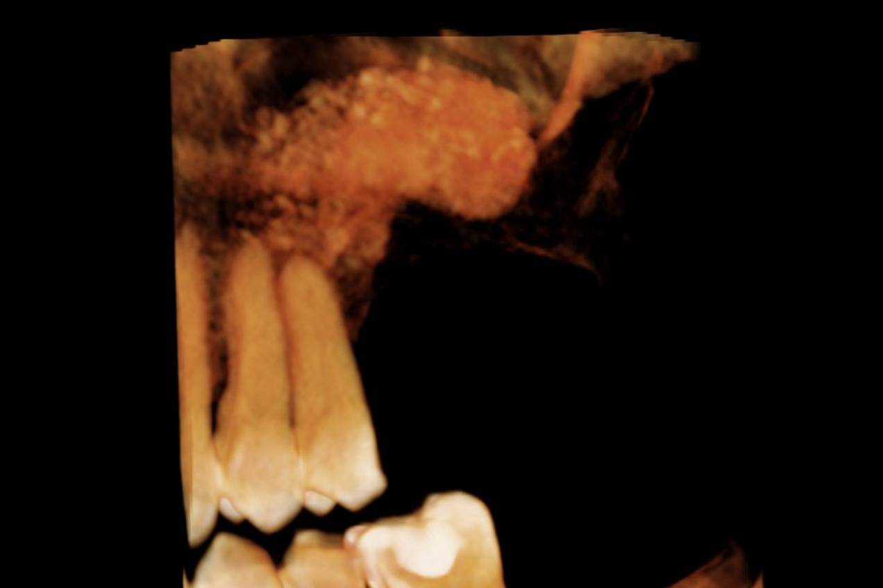 rialzo_mascella03_desk