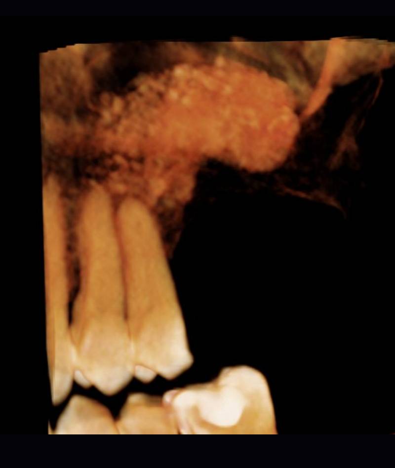 rialzo_mascella03_mob