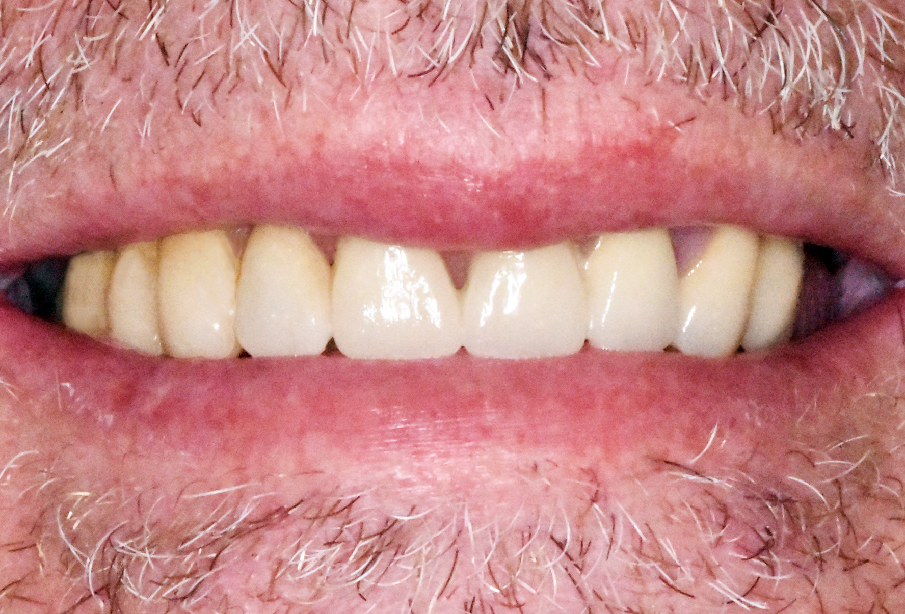 protesi-zirconia dopo